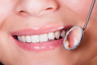 Tooth Colored Fillings Montrose | White Fillings Montrose