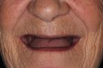 Complete-Dentures-Before-Image
