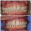 Six-Month-Cosmetic-Braces-Before-Image