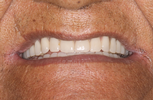 Beautiful-Natural-Looking-Dentures-After-Image