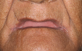 Beautiful-Natural-Looking-Dentures-Before-Image