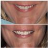 Six-Month-Cosmetic-Braces-After-Image