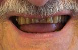 Porcelain-Crowns-transformed-this-smile-Before-Image