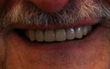 Porcelain-Crowns-transformed-this-smile-After-Image