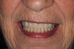Complete-Dentures-After-Image